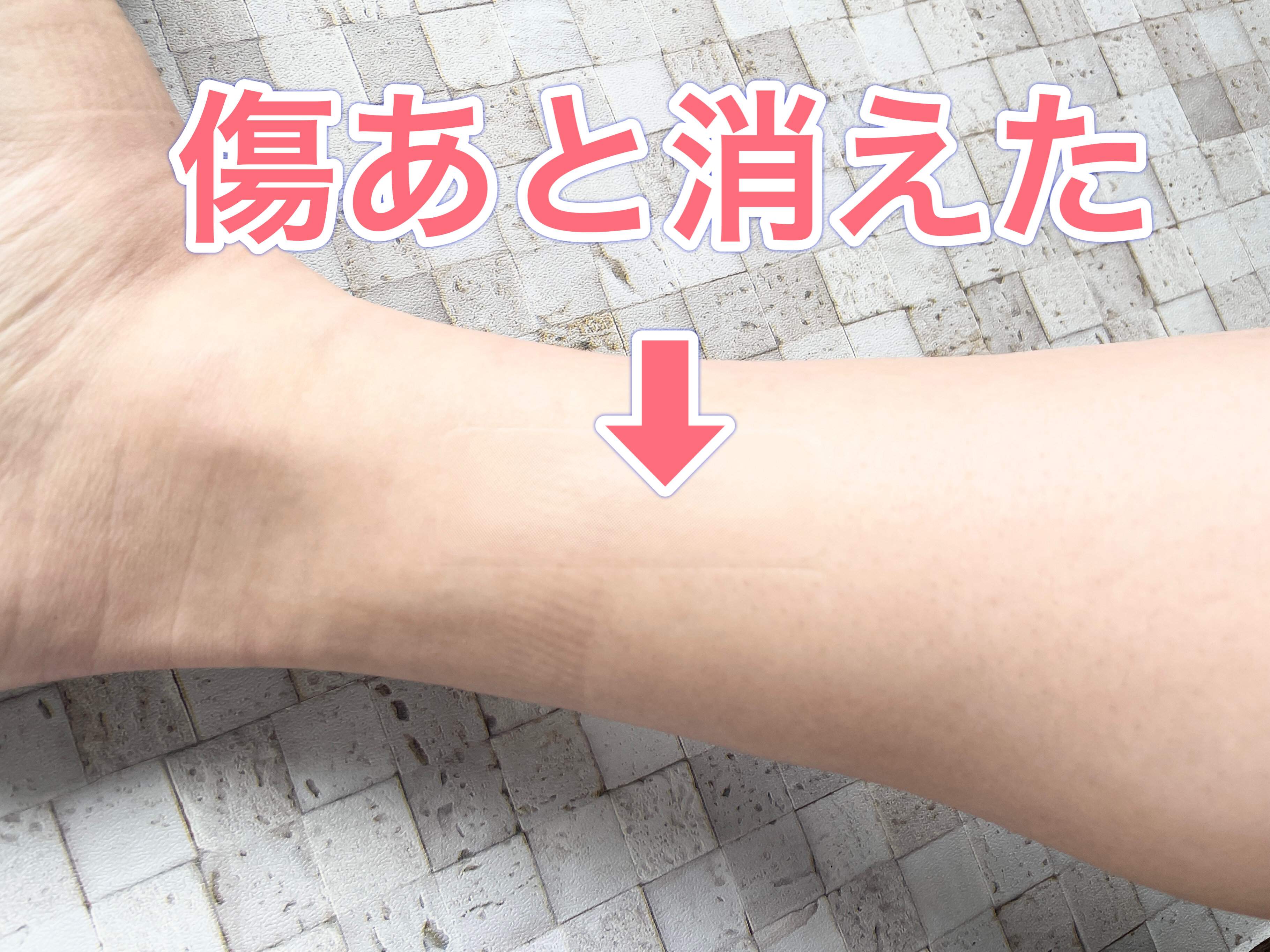 【ダイソー】これで肌見せも怖くない!?「ファンデシート」で傷あとが簡単に隠せる！