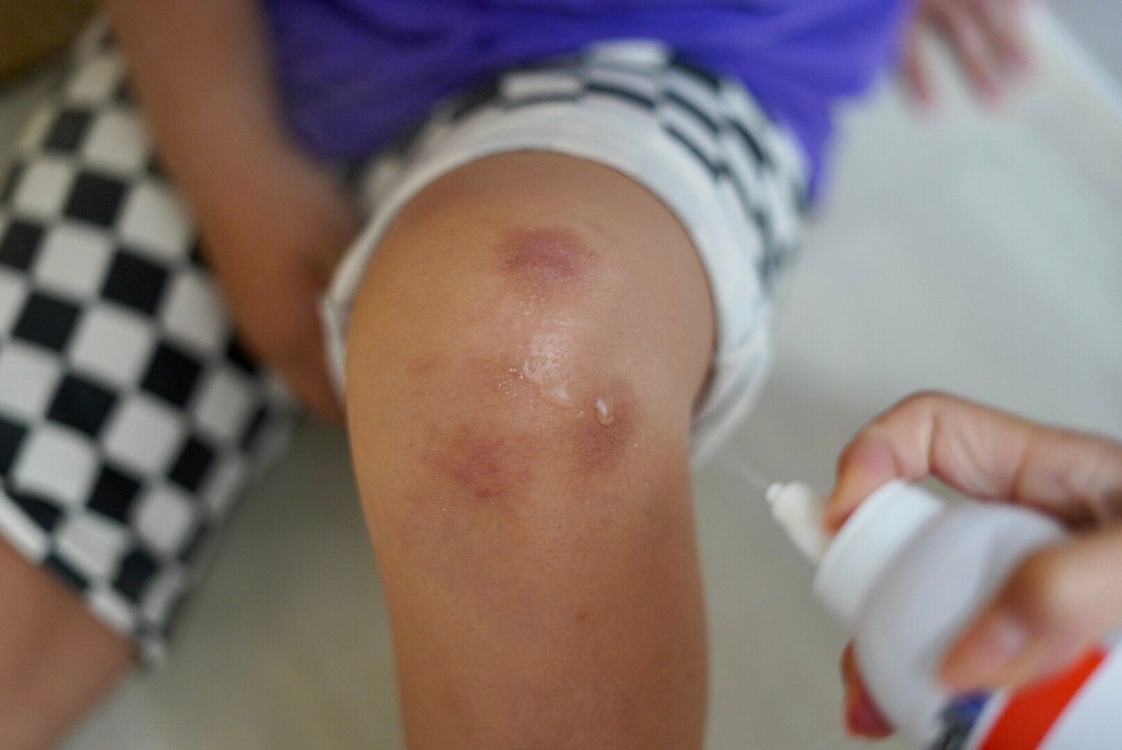 思わぬ怪我にも安心！痛くない、傷にしっかりアプローチする2アイテム◎