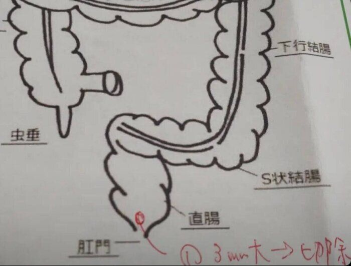【健康】アラフォー主婦の大腸カメラ体験記